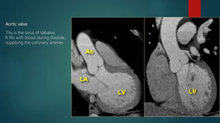 Aortic valve
This is the sinus of Valsalva.
It fills with blood during diastole,
supplying the coronary arteries
 