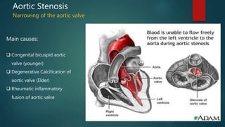 Aortic Stenosis
Narrowing of the aortic valve
Main causes:
 Congenital bicuspid aortic
valve (younger)
 Degenerative Calcification of
aortic valve (Elder)
 Rheumatic inflammatory
fusion of aortic valve
 