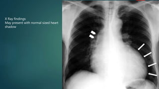 X Ray findings
May present with normal sized heart
shadow
 