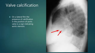 Valve calcification
 On a lateral film the
presence of calcification
in the position of aortic
valve is a sign indicating
aortic stenosis.
 
