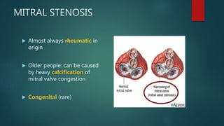 MITRAL STENOSIS
 Almost always rheumatic in
origin
 Older people: can be caused
by heavy calcification of
mitral valve congestion
 Congenital (rare)
 