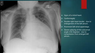  Signs of a mitral heart:
 Cardiomegaly
 Double right heart border - due to
enlargement of the left atrium.
 Prominent left atrial appendage.
 Severe splaying of the subcarinal
angle (150 degrees) - due to
compression from enlarged left
atrium.
 