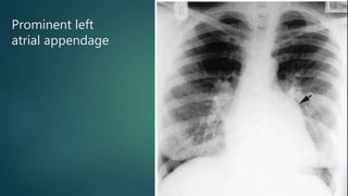 Prominent left
atrial appendage
 