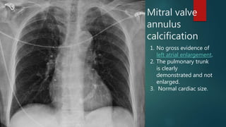 Mitral valve
annulus
calcification
1. No gross evidence of
left atrial enlargement.
2. The pulmonary trunk
is clearly
demonstrated and not
enlarged.
3. Normal cardiac size.
 