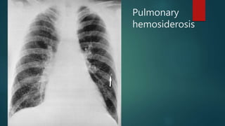 Pulmonary
hemosiderosis
 
