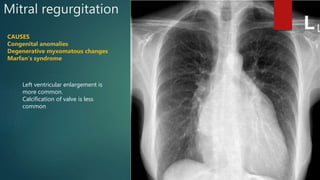 Mitral regurgitation
CAUSES
Congenital anomalies
Degenerative myxomatous changes
Marfan’s syndrome
Left ventricular enlargement is
more common.
Calcification of valve is less
common
 