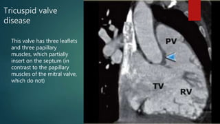 Tricuspid valve
disease
This valve has three leaflets
and three papillary
muscles, which partially
insert on the septum (in
contrast to the papillary
muscles of the mitral valve,
which do not)
 