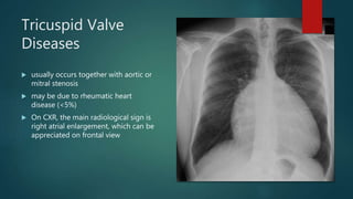 Tricuspid Valve
Diseases
 usually occurs together with aortic or
mitral stenosis
 may be due to rheumatic heart
disease (<5%)
 On CXR, the main radiological sign is
right atrial enlargement, which can be
appreciated on frontal view
 