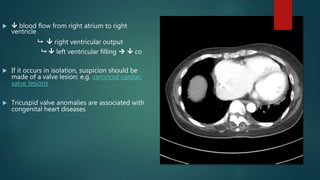   blood flow from right atrium to right
ventricle
  right ventricular output
  left ventricular filling   co
 If it occurs in isolation, suspicion should be
made of a valve lesion: e.g. carcinoid cardiac
valve lesions
 Tricuspid valve anomalies are associated with
congenital heart diseases
 