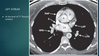 LEFT ATRIUM
 At the level of 7th Thoracic
vertebra
 