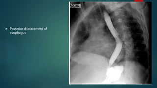  Posterior displacement of
esophagus
 