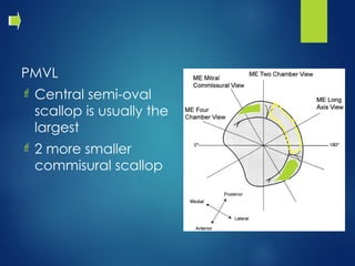 Valvular Heart Disease Valvular Heart Disease | PPT