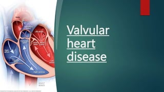 Valvular
heart
disease
 