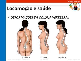 Sistema muscular




Locomoção e saúde
 • DEFORMAÇÕES DA COLUNA VERTEBRAL




                      Escoliose       Cifose       Lordose
Ciências – 8º ano Ens. Fundamental   4º Bimestre             Profa. Rebeca Vale
 