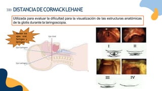 Utilizada para evaluar la dificultad para la visualización de las estructuras anatómicas
de la glotis durante la laringoscopia.
Alinear los
ejes oral,
faríngeo y
laríngeo.
DISTANCIADECORMACKLEHANE
 