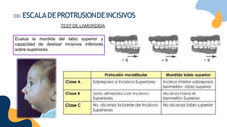 Evalúa la mordida del labio superior y
capacidad de deslizar incisivos inferiores
sobre superiores.
ESCALADEPROTRUSIONDEINCISIVOS
TEST DE LAMORDIDA
 