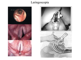 Laringoscopia 