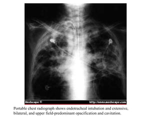 Portable chest radiograph shows endotracheal intubation and extensive,  bilateral, and upper field-predominant opacification and cavitation. 