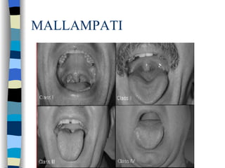 MALLAMPATI 