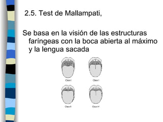 2.5. Test de Mallampati,  Se basa en la visión de las estructuras faríngeas con la boca abierta al máximo y la lengua sacada 
