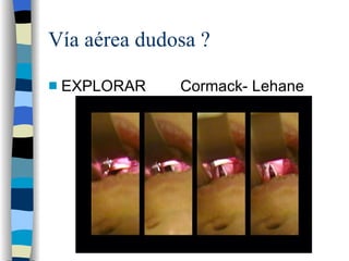 Vía aérea dudosa ? EXPLORAR  Cormack- Lehane 
