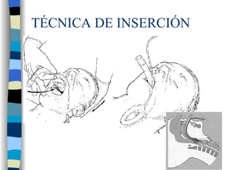 TÉCNICA DE INSERCIÓN 