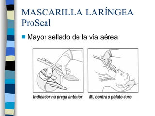 MASCARILLA LARÍNGEA ProSeal Mayor sellado de la vía aérea 