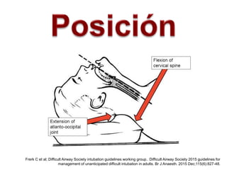 Frerk C et al; Difficult Airway Society intubation guidelines working group.. Difficult Airway Society 2015 guidelines for
management of unanticipated difficult intubation in adults. Br J Anaesth. 2015 Dec;115(6):827-48.
 