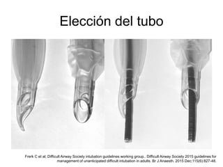 Elección del tubo
Frerk C et al; Difficult Airway Society intubation guidelines working group.. Difficult Airway Society 2015 guidelines for
management of unanticipated difficult intubation in adults. Br J Anaesth. 2015 Dec;115(6):827-48.
 