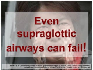 Frerk C et al; Difficult Airway Society intubation guidelines working group.. Difficult Airway Society 2015 guidelines for
management of unanticipated difficult intubation in adults. Br J Anaesth. 2015 Dec;115(6):827-48.
 