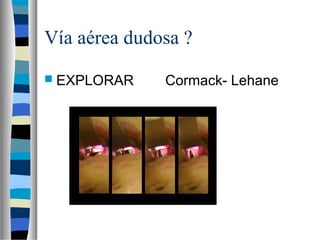 Vía aérea dudosa ?
 EXPLORAR Cormack- Lehane
 