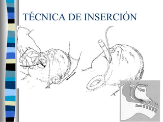 TÉCNICA DE INSERCIÓN
 