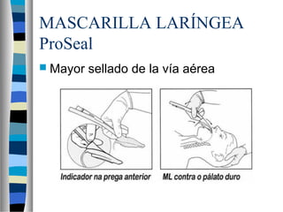 MASCARILLA LARÍNGEA
ProSeal
 Mayor sellado de la vía aérea
 