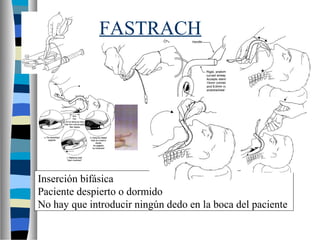 Inserción bifásica
Paciente despierto o dormido
No hay que introducir ningún dedo en la boca del paciente
FASTRACH
 