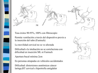 Tasa éxitos 90-95%, 100% con fibroscopio
Permite ventilación a través del dispositivo previo a
la inserción del tubo (Fastrach)
La movilidad cervical no se ve afectada
Dificultad a la intubación no se correlaciona con
dificultad en inserción ML ni Fastrach
Apertura bucal mínima 2cm
En personas atrapadas en vehículos accidentados
Dificultad: distorsiones anatómicas cáncer
laringe,RT cervical e hipertrofia amigdalar
 