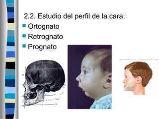 2.2. Estudio del perfil de la cara:
 Ortognato
 Retrognato
 Prognato
 