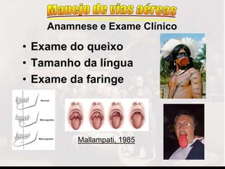 • Exame do queixo
• Tamanho da língua
• Exame da faringe
Anamnese e Exame Clínico
Mallampati, 1985
 