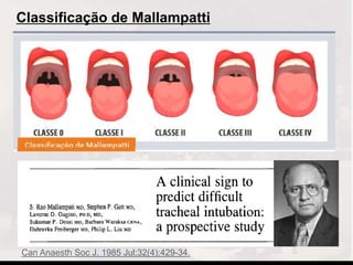 Classificação de Mallampatti
Can Anaesth Soc J. 1985 Jul;32(4):429-34.
 