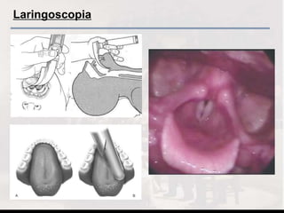 Laringoscopia
 