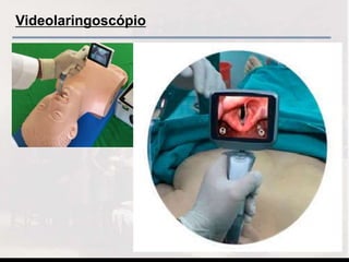 Videolaringoscópio
 