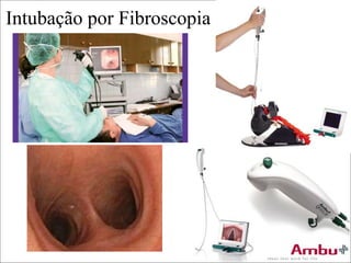 Intubação por Fibroscopia
 