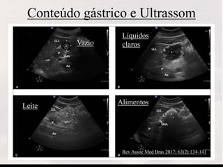 Conteúdo gástrico e Ultrassom
Vazio
Líquidos
claros
Leite Alimentos
Rev Assoc Med Bras 2017; 63(2):134-141
 