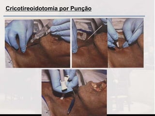 Cricotireoidotomia por Punção
 