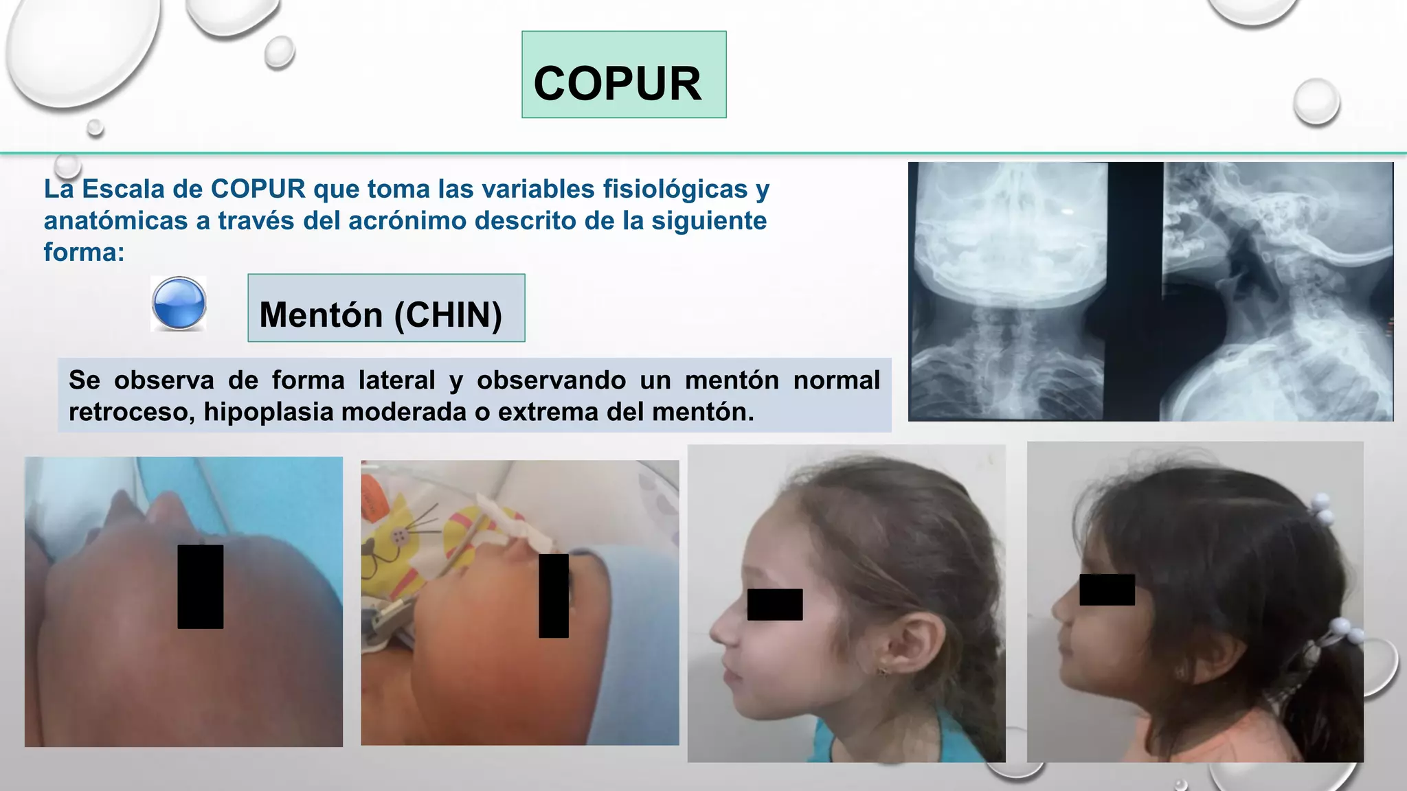ESCALA DE COPUR VIA AEREA DIFICIL PEDIATRICA | PDF