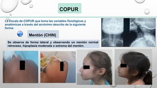 ESCALA DE COPUR VIA AEREA DIFICIL PEDIATRICA | PDF