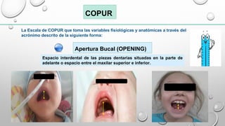 ESCALA DE COPUR VIA AEREA DIFICIL PEDIATRICA | PDF