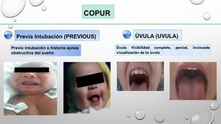 ESCALA DE COPUR VIA AEREA DIFICIL PEDIATRICA | PDF