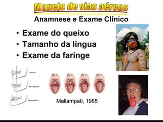 Exame do queixo Tamanho da língua Exame da faringe Anamnese e Exame Clínico Mallampati, 1985 