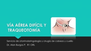 VÍA AÉREA DIFÍCIL Y
TRAQUEOTOMÍA
Servicio de otorrinolaringología y cirugía de cabeza y cuello

Dr. Alan Burgos P. R1 ORL

 