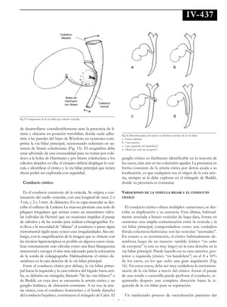 IV-437

                                       Coledoco
                                        dilatado




                                                                                      a                                        b




                                            Bolsa de
                                           Hartmann
                                           con litiasis       Coledoco
                                                               normal


                                                                                      c                                        d
Fig. 15. Compresión de la vía biliar por cálculo vesicular.


de desarrollarse considerablemente ante la presencia de li-
tiasis y ubicarse en posición retrohiliar, donde suele adhe-                 Fig. 16. Desembocadura del cístico en distintos sectores de la vía biliar.
rirse a las paredes del hiato de Winslow; en ocasiones com-                  a.- Forma habitual.
prime la vía biliar principal, ocasionando colestasis en au-                 b.- Cara anterior.

sencia de litiasis coledociana (Fig. 15). El ecografista debe
                                                                             c.- Cara izquierda (ën bandolera”)
                                                                             d.- Distal (ën caño de escopeta”)
estar advertido de esta eventualidad para no tomar por colé-
doco a la bolsa de Hartmann y por litiasis coledociana a los                 ganglio cístico es fácilmente identificable en la mayoría de
cálculos alojados en ella; el cirujano deberá desplegar la vesí-             los casos, más aún en las colecistitis agudas. La presencia en
cula e identificar el cístico y la vía biliar principal que recién           forma constante de la arteria cística por detrás ayuda a su
ahora podrá ser explorada con seguridad.                                     localización, ya que cualquiera sea el origen de la esta arte-
                                                                             ria, siempre se la debe explorar en el triángulo de Buddé,
  Conducto cístico                                                           donde su presencia es constante.

   Es el conducto excretorio de la vesícula. Se origina a con-               VARIACIONES DE LA VESÍCULA BILIAR Y EL CONDUCTO
tinuación del cuello vesicular, con una longitud de unos 2 ó                 CÍSTICO
3 cm, y 2 a 3 mm. de diámetro. En su capa muscular se des-
cribe el esfínter de Lutkens La mucosa presenta una serie de                   El conducto cístico ofrece múltiples variaciones; se des-
pliegues irregulares que actúan como un mecanismo valvu-                     cribe su duplicación y su ausencia. Esta última, habitual-
lar (válvulas de Heister) que en ocasiones impiden el pasaje                 mente asociada a litiasis vesicular de larga data, forma en
de cálculos y de las sondas para realizar colangiografías. Es-               ocasiones una amplia comunicación entre la vesícula y la
to lleva a la necesidad de “dilatar” el conducto o pasar algún               vía biliar principal, comportándose como una verdadera
instrumental rígido para vencer esas irregularidades. Sin em-                fístula colecistocoledociana: son las vesículas “asentadas”.
bargo, con la magnificación de la imagen que se obtiene con                  En cuanto a su terminación, el cístico habitualmente de-
las técnicas laparoscópicas es posible en algunos casos visua-               semboca luego de un trayecto variable (cístico “en caño
lizar externamente esas válvulas como una línea blanquecina                  de escopeta” si este es muy largo) en la cara derecha en la
transversal y escoger el sitio más adecuado para la colocación               vía biliar principal. Puede hacerlo en su cara anterior, pos-
de la sonda de colangiografía. Habitualmente el cístico de-                  terior o izquierda (cístico “en bandolera”) en el 8 a 10%
semboca en la cara derecha de la vía biliar principal.                       de los casos, en los que sufre una gran angulación (Fig.
   Entre el conducto cístico por debajo, la vía biliar princi-               16). En estos casos, debe ser muy cuidadosa la instrumen-
pal hacia la izquierda y la cara inferior del hígado hacia arri-             tación de la vía biliar a través del cístico; forzar el pasaje
ba, se delimita un triángulo, llamado "de las vías biliares" o               de una sonda o canastilla puede perforar el conducto, re-
de Buddé, en cuya área se encuentra la arteria cística y un                  quiriendo después una completa disección hasta la iz-
ganglio linfático, de ubicación constante. A su vez, la arte-                quierda de la vía biliar para su reparación.
ria cística, con el conducto homónimo y el borde derecho
del conducto hepático, constituyen el triángulo de Calot. El                   Un inadecuado proceso de vacuolización pareciera dar
                                                                         9
 